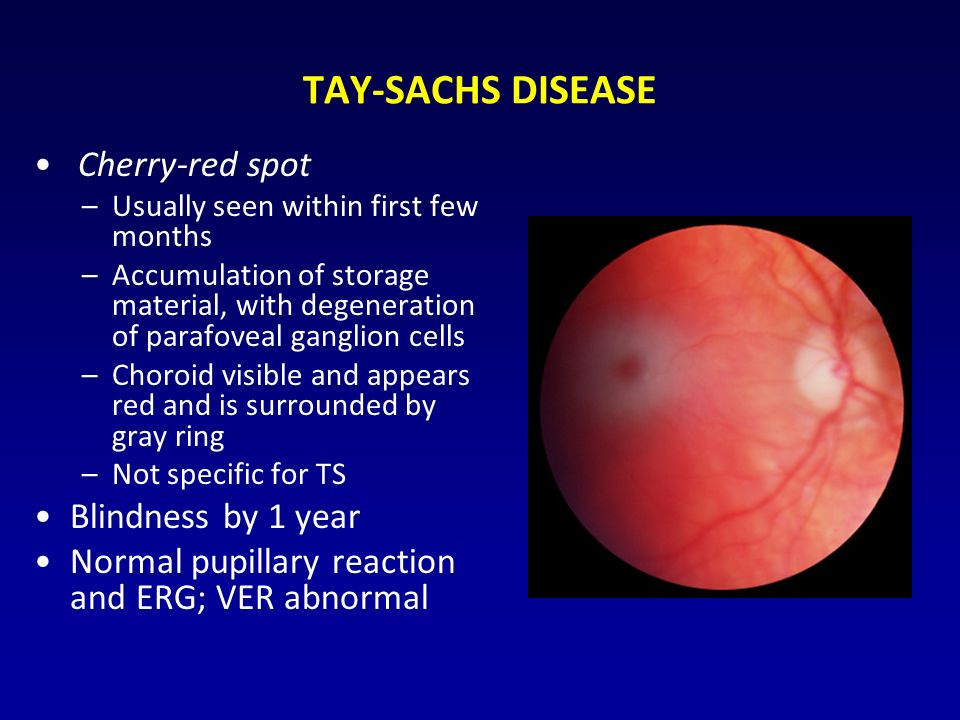 TAY-SACHS DISEASE Cherry-red spot –Usually seen within first few months –Accumulation of storage material, with degeneration of parafoveal ganglion cells –Choroid visible and appears red and is surrounded by gray ring –Not specific for TS Blindness by 1 year Normal pupillary reaction and ERG; VER abnormal
