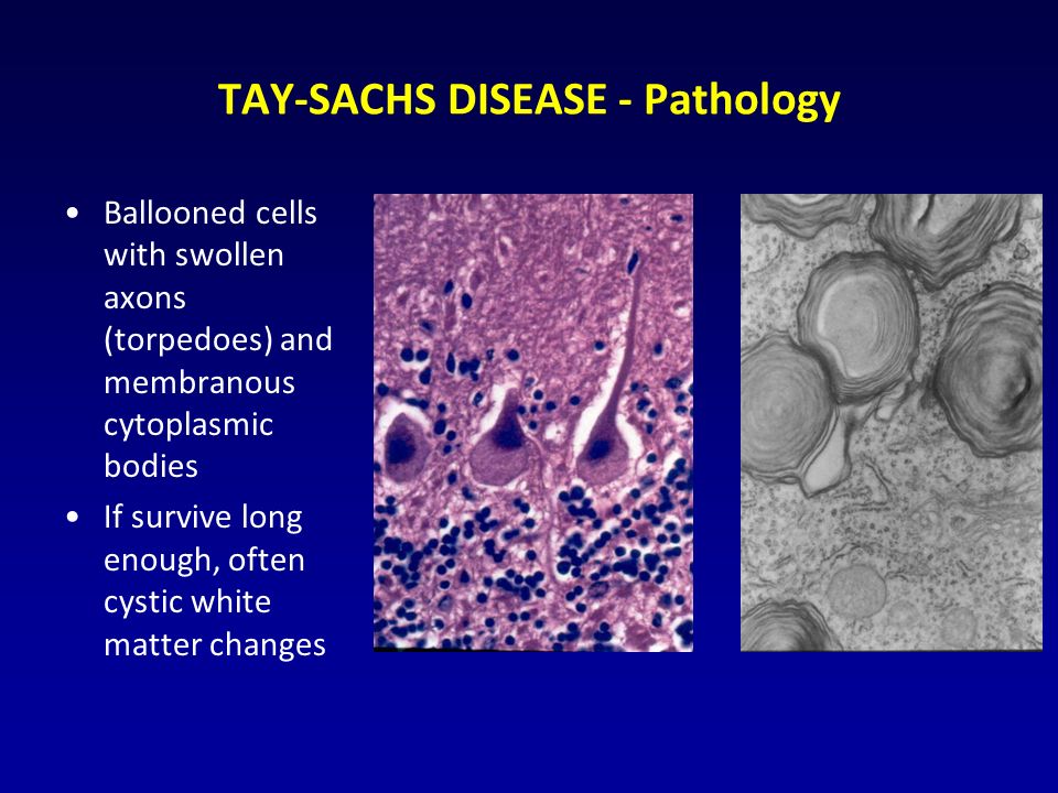 TAY-SACHS DISEASE - Pathology Ballooned cells with swollen axons (torpedoes) and membranous cytoplasmic bodies If survive long enough, often cystic white matter changes