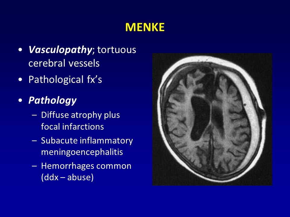 MENKE Vasculopathy; tortuous cerebral vessels Pathological fx’s Pathology –Diffuse atrophy plus focal infarctions –Subacute inflammatory meningoencephalitis –Hemorrhages common (ddx – abuse)