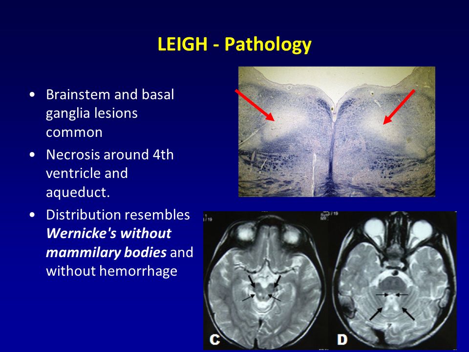 LEIGH - Pathology Brainstem and basal ganglia lesions common Necrosis around 4th ventricle and aqueduct.