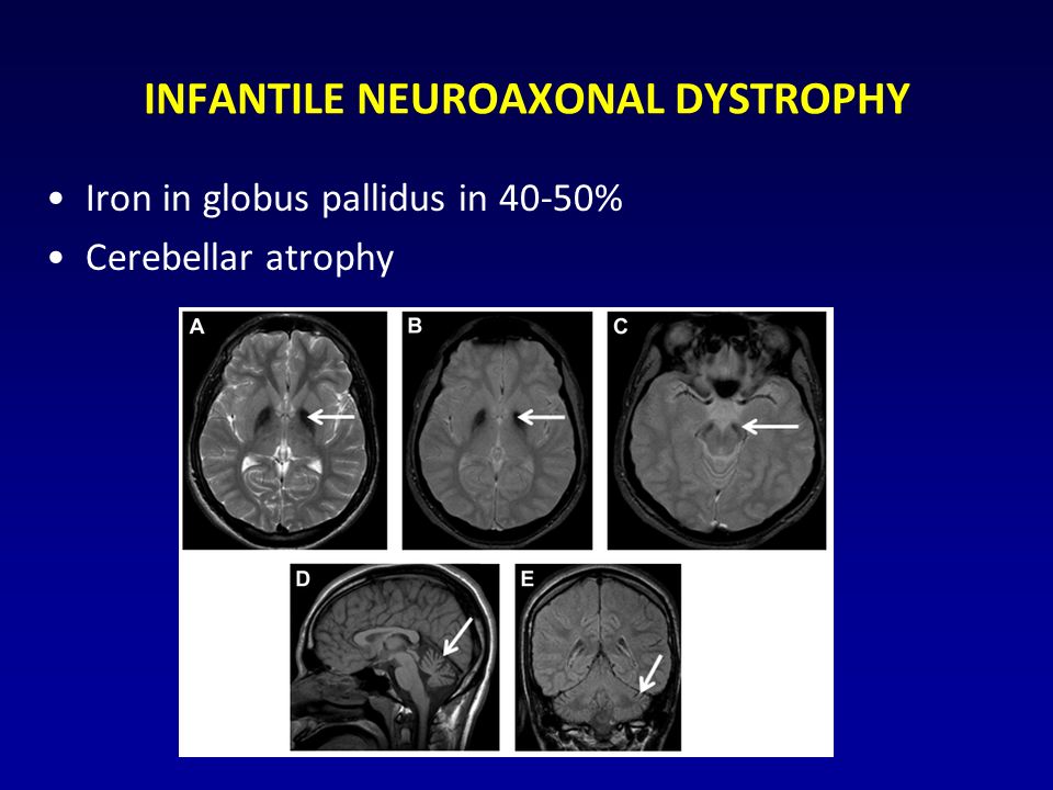 INFANTILE NEUROAXONAL DYSTROPHY Iron in globus pallidus in 40-50% Cerebellar atrophy