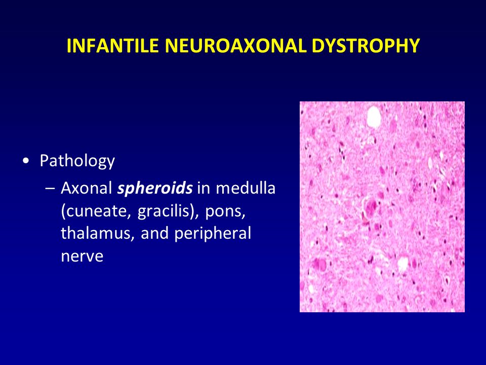 INFANTILE NEUROAXONAL DYSTROPHY Pathology –Axonal spheroids in medulla (cuneate, gracilis), pons, thalamus, and peripheral nerve