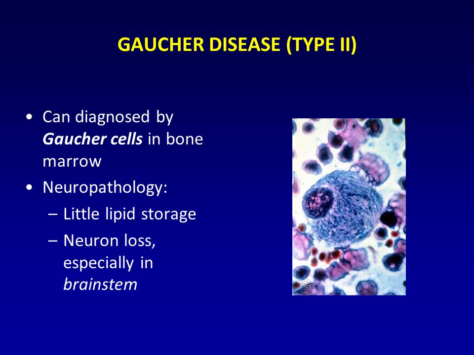 GAUCHER DISEASE (TYPE II) Can diagnosed by Gaucher cells in bone marrow Neuropathology: –Little lipid storage –Neuron loss, especially in brainstem