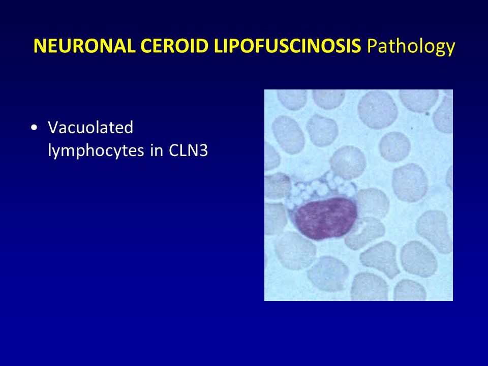 NEURONAL CEROID LIPOFUSCINOSIS Pathology Vacuolated lymphocytes in CLN3