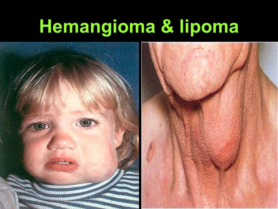 LIPOMA PPT lipoma ppt: