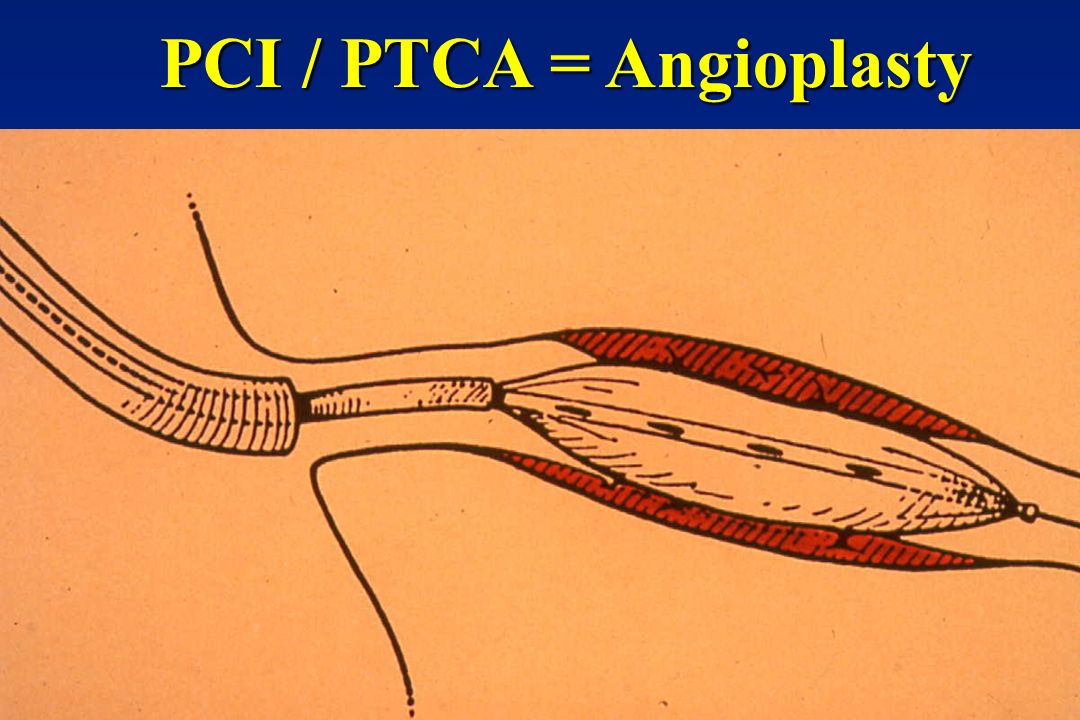 percutaneous transluminal coronary angioplasty essay percutaneous transluminal coronary angioplasty essay