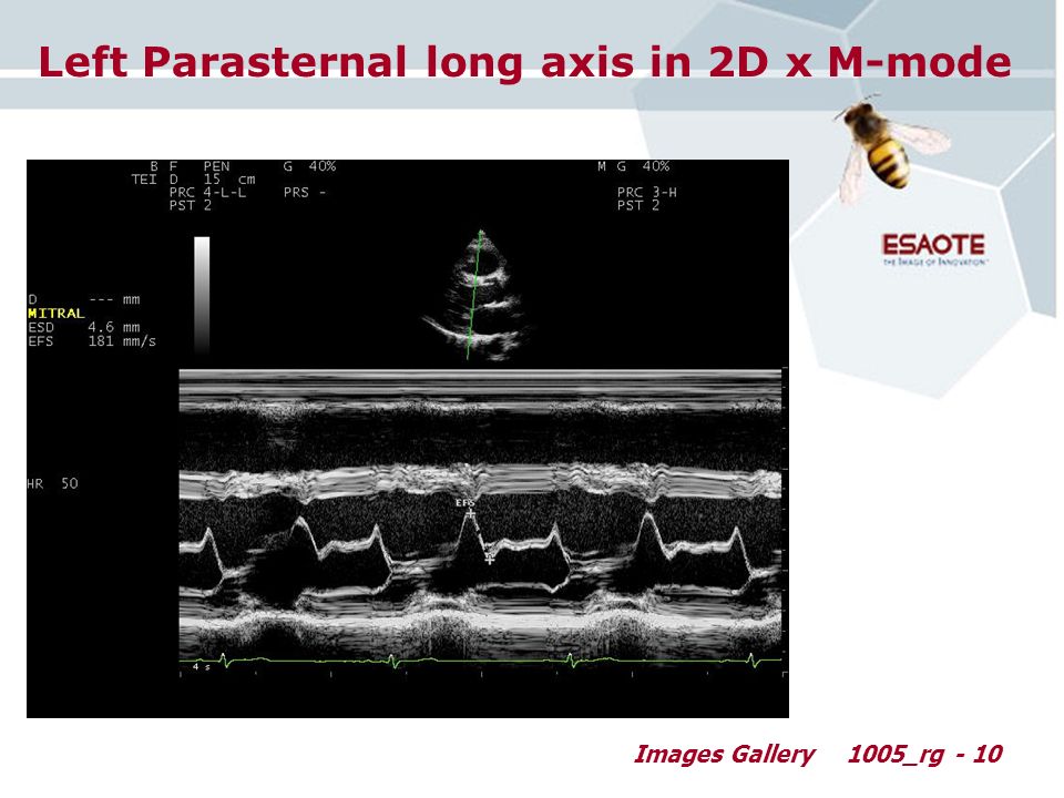 Images Gallery1005_rg - 10 Left Parasternal long axis in 2D x M-mode