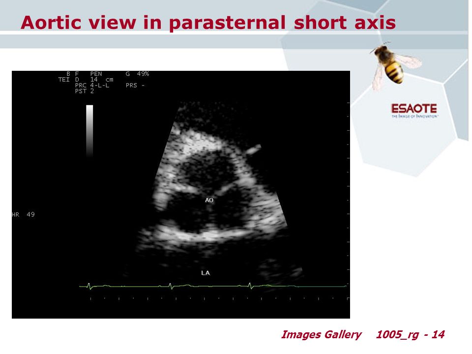 Images Gallery1005_rg - 14 Aortic view in parasternal short axis