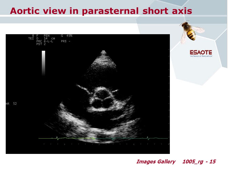 Images Gallery1005_rg - 15 Aortic view in parasternal short axis