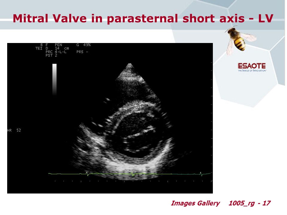 Images Gallery1005_rg - 17 Mitral Valve in parasternal short axis - LV