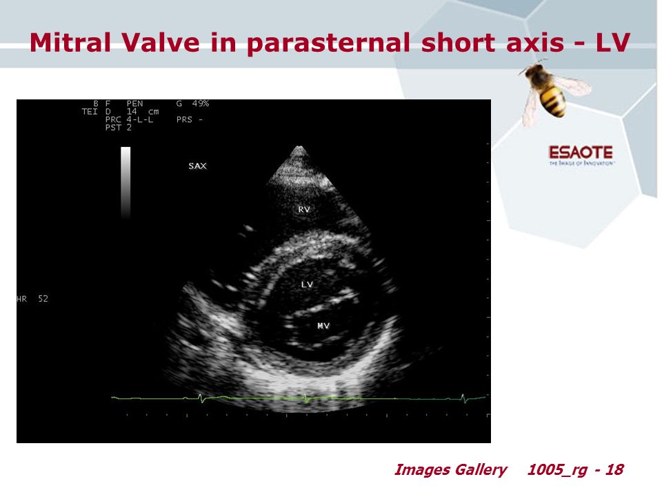 Images Gallery1005_rg - 18 Mitral Valve in parasternal short axis - LV