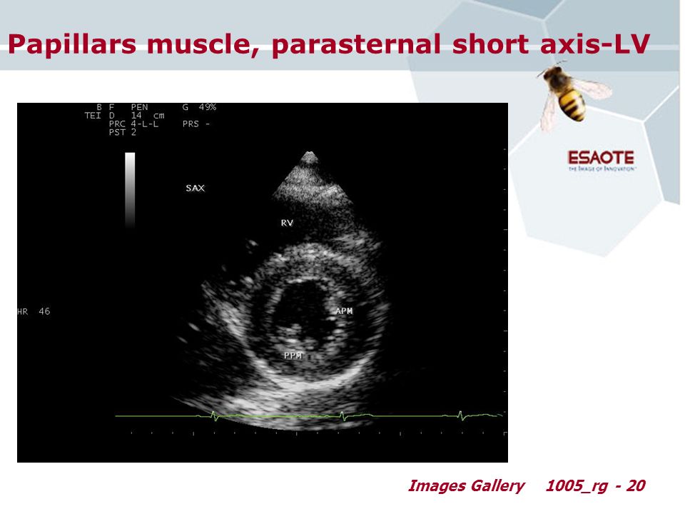 Images Gallery1005_rg - 20 Papillars muscle, parasternal short axis-LV