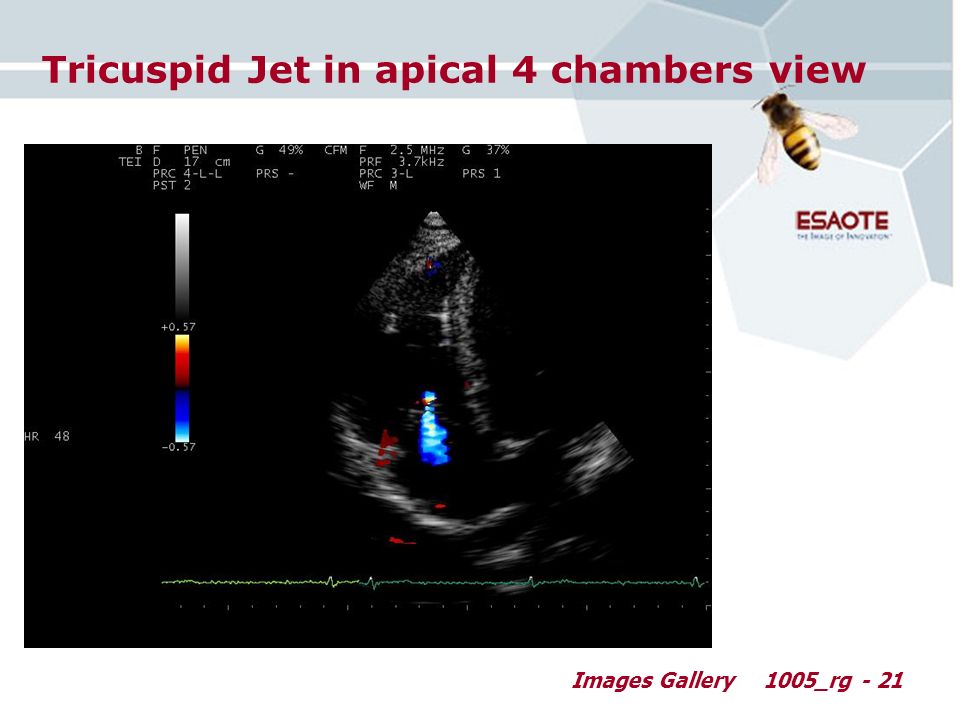 Images Gallery1005_rg - 21 Tricuspid Jet in apical 4 chambers view