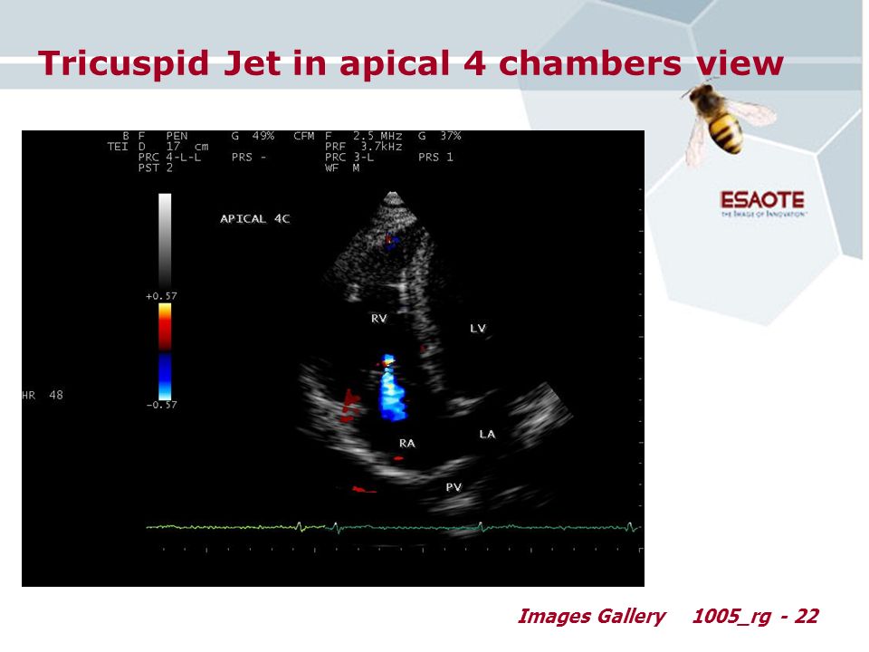 Images Gallery1005_rg - 22 Tricuspid Jet in apical 4 chambers view
