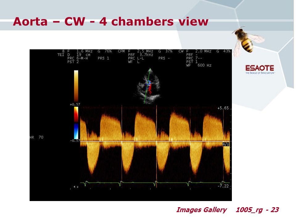 Images Gallery1005_rg - 23 Aorta – CW - 4 chambers view