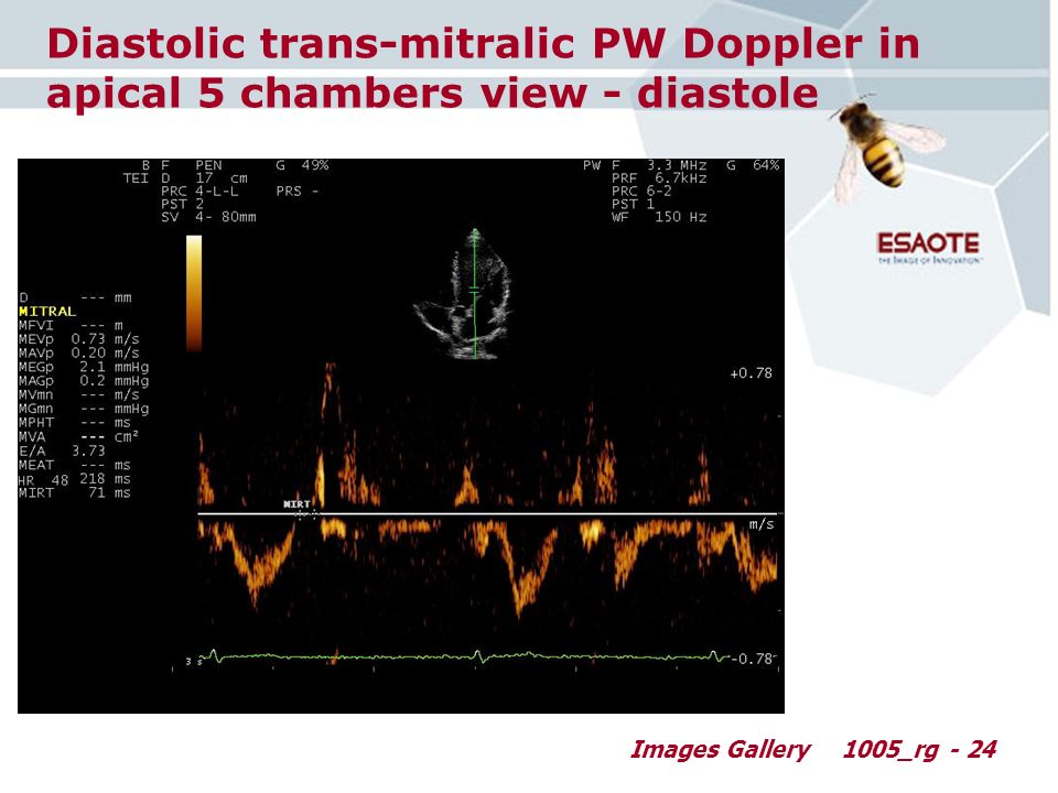 Images Gallery1005_rg - 24 Diastolic trans-mitralic PW Doppler in apical 5 chambers view - diastole