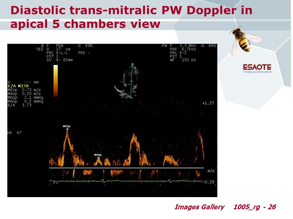 Images Gallery1005_rg - 26 Diastolic trans-mitralic PW Doppler in apical 5 chambers view