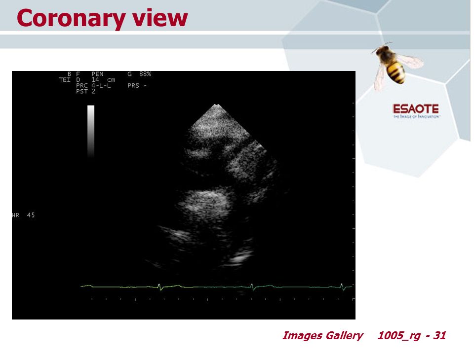 Images Gallery1005_rg - 31 Coronary view