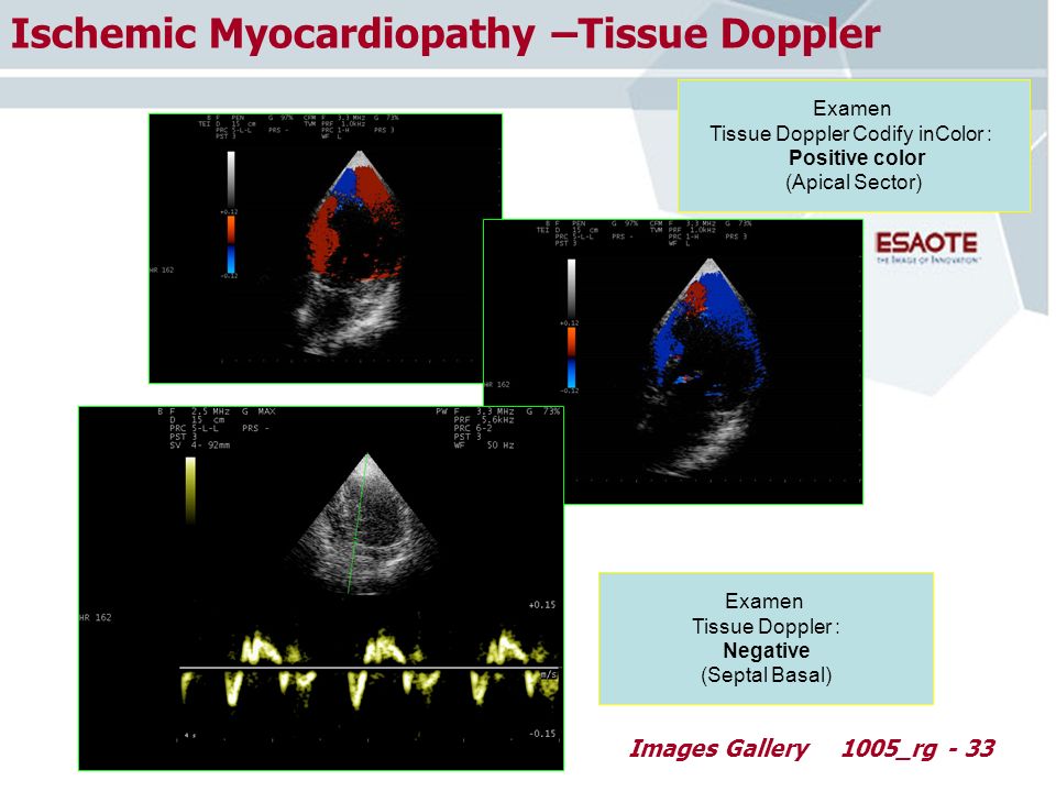 Images Gallery1005_rg - 33 Ischemic Myocardiopathy –Tissue Doppler Examen Tissue Doppler : Negative (Septal Basal) Examen Tissue Doppler Codify inColor : Positive color (Apical Sector)