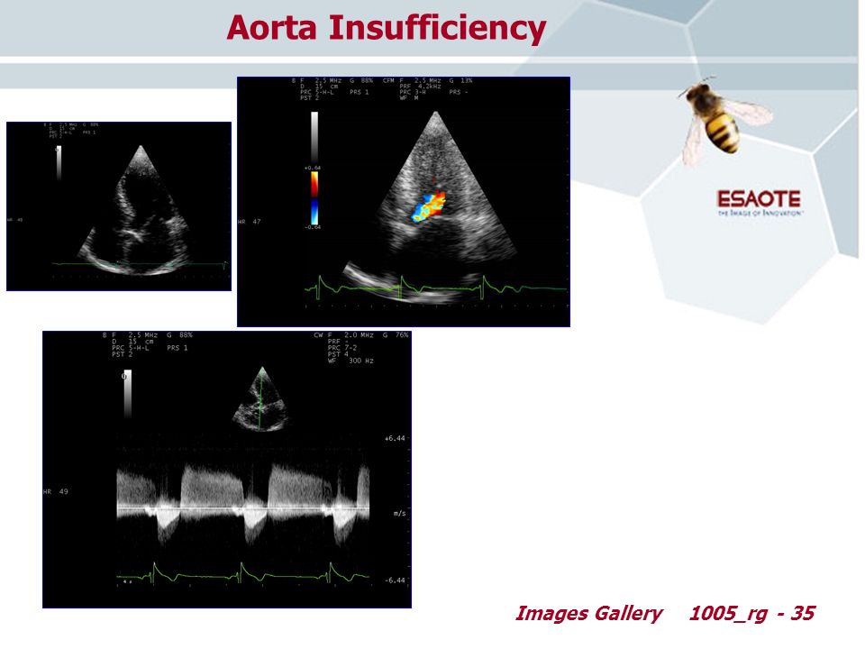 Images Gallery1005_rg - 35 Aorta Insufficiency
