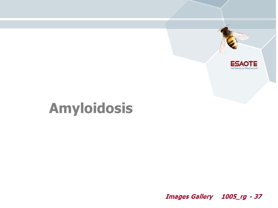 Images Gallery1005_rg - 37 Amyloidosis