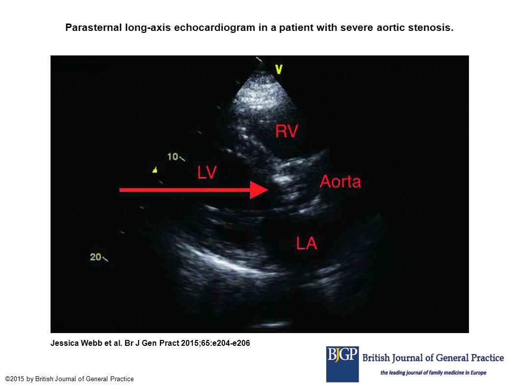 Parasternal long-axis echocardiogram in a patient with severe aortic stenosis.