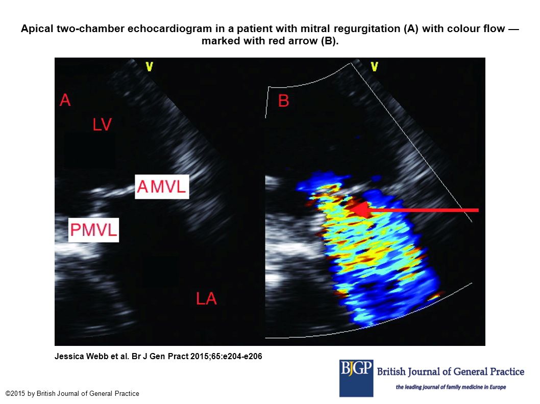 Apical two-chamber echocardiogram in a patient with mitral regurgitation (A) with colour flow — marked with red arrow (B).