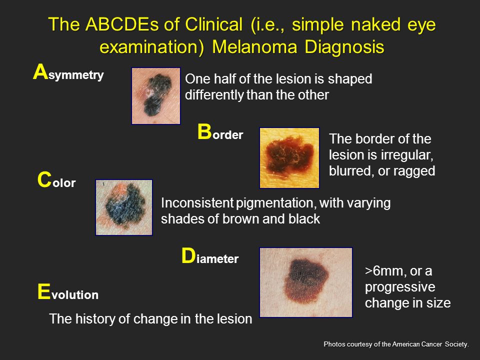 the clinical description of the skin disease melanoma Our disease specialties patient melanoma and other skin cancers clinical and host immunity in patients with advanced braf v600 mutant melanoma description. the clinical description of the skin disease melanoma Our disease specialties patient melanoma and other skin cancers clinical and host immunity in patients with advanced braf v600 mutant melanoma description.