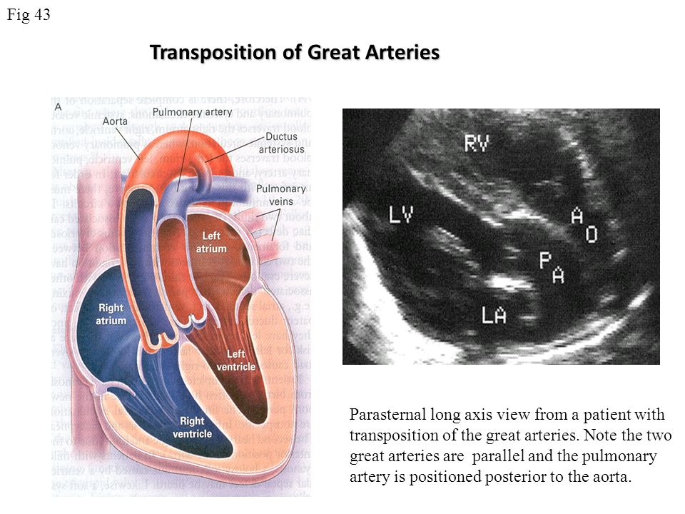 Transposition of Great Arteries Parasternal long axis view from a patient with transposition of the great arteries.
