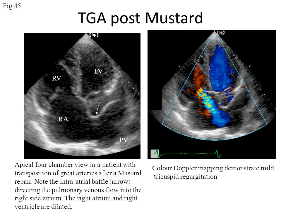 TGA post Mustard Apical four chamber view in a patient with transposition of great arteries after a Mustard repair.