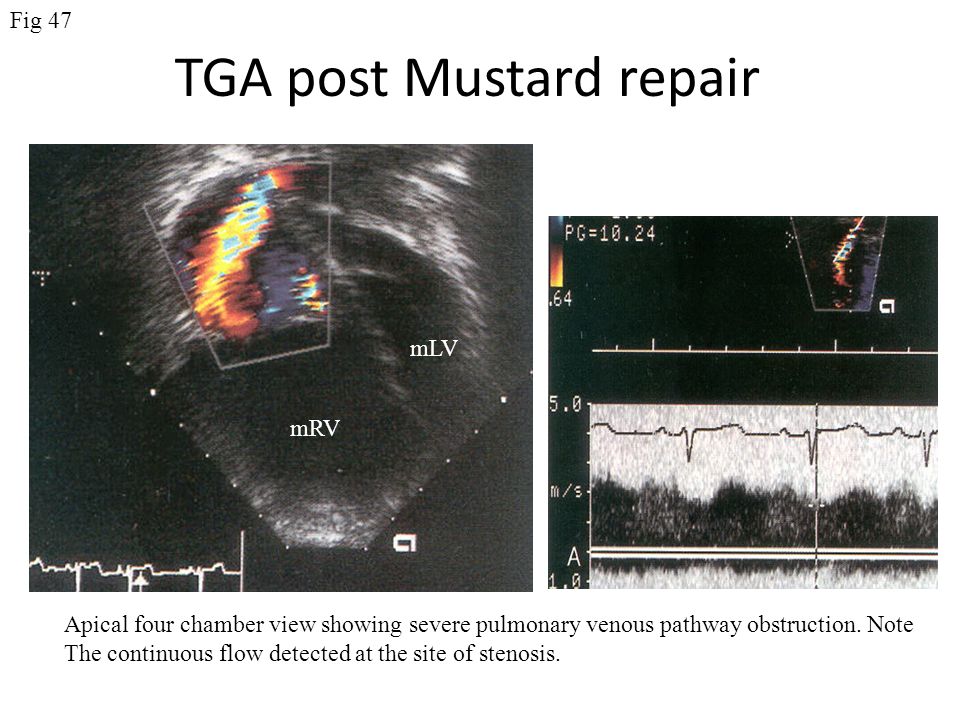 TGA post Mustard repair Apical four chamber view showing severe pulmonary venous pathway obstruction.