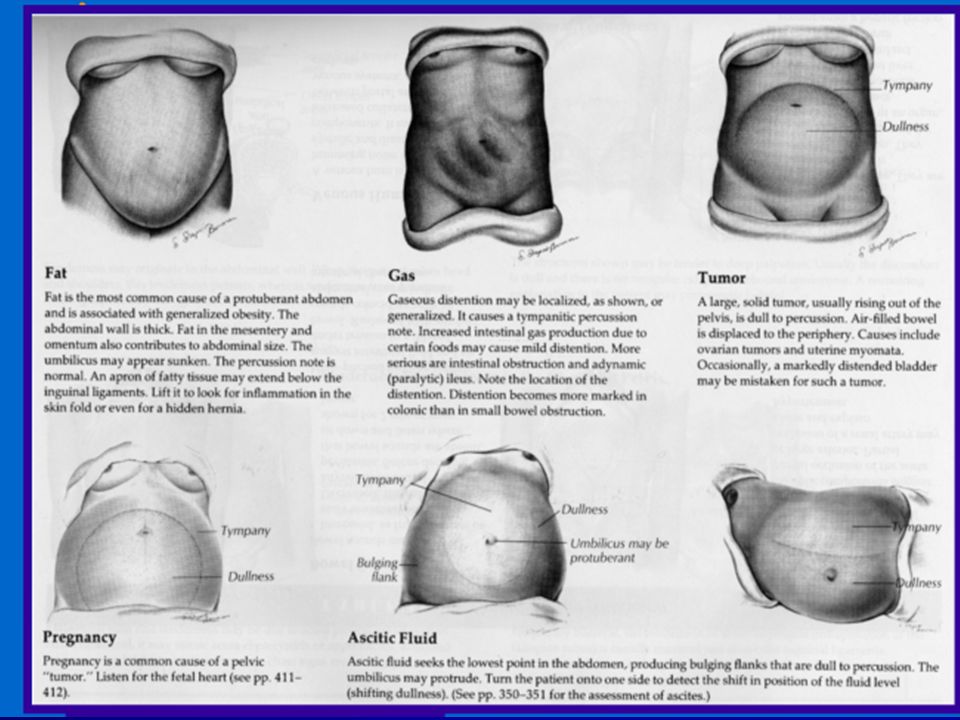Abdominal auscultation with bowel obstruction
