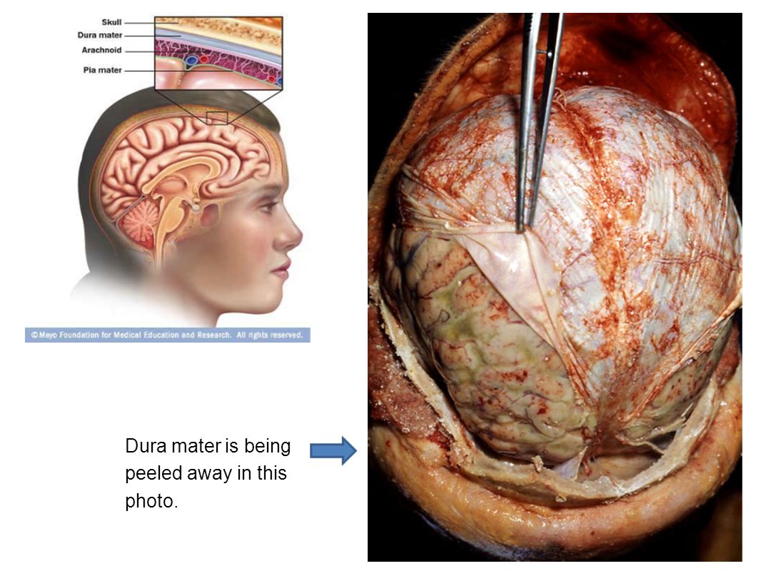 Dura mater is being peeled away in this photo.