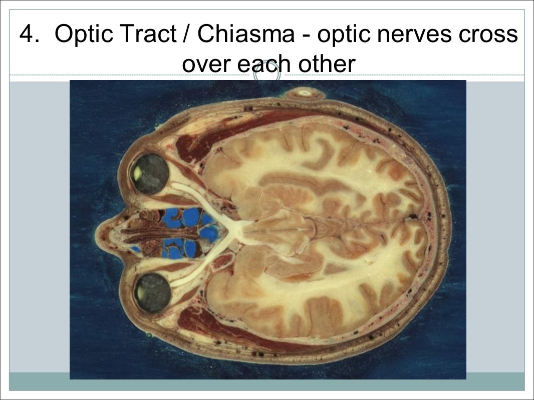 4. Optic Tract / Chiasma - optic nerves cross over each other