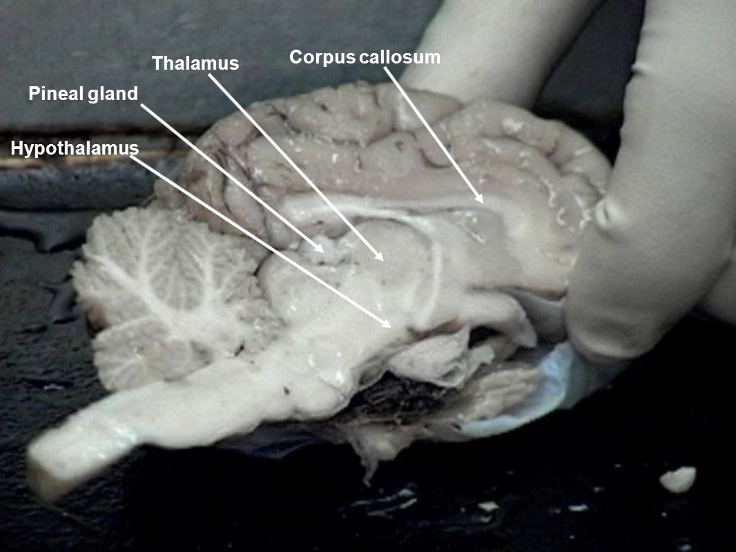 Corpus callosum Thalamus Hypothalamus Pineal gland