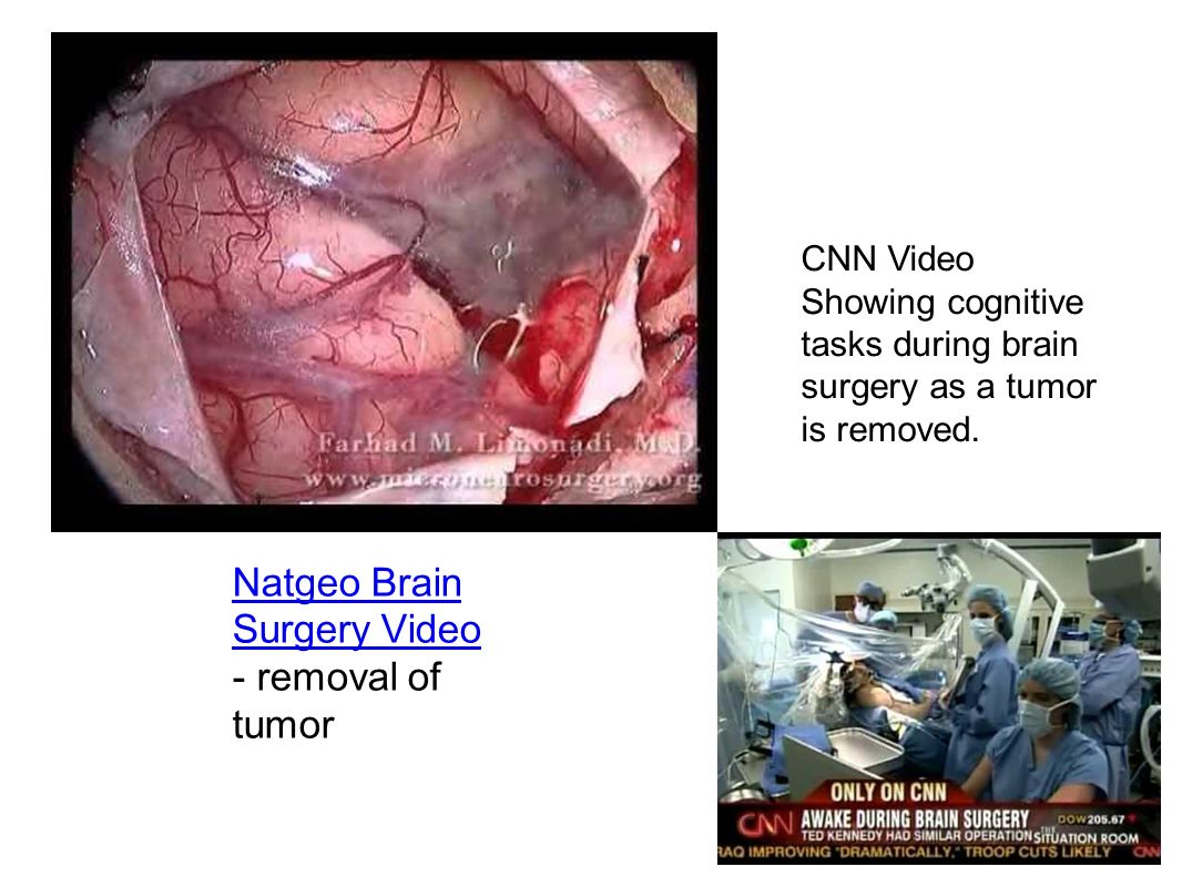 Natgeo Brain Surgery Video Natgeo Brain Surgery Video - removal of tumor CNN Video Showing cognitive tasks during brain surgery as a tumor is removed.