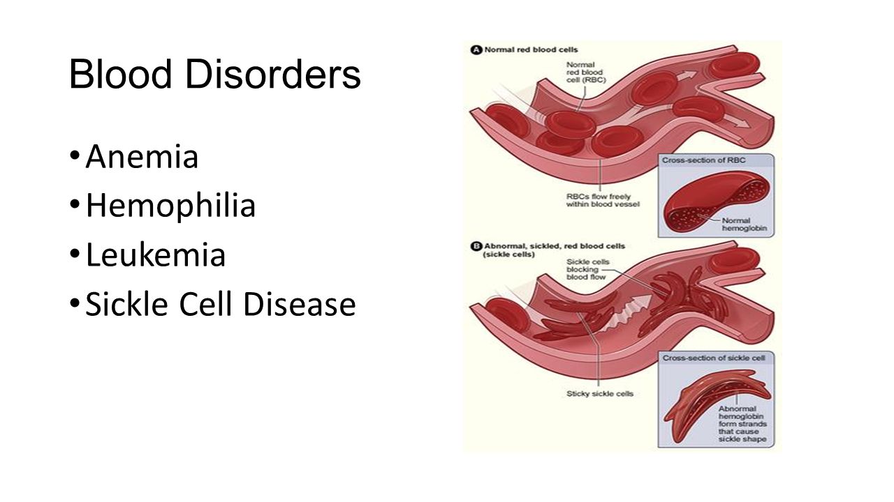 Blood Disorders Anemia Hemophilia Leukemia Sickle Cell Disease