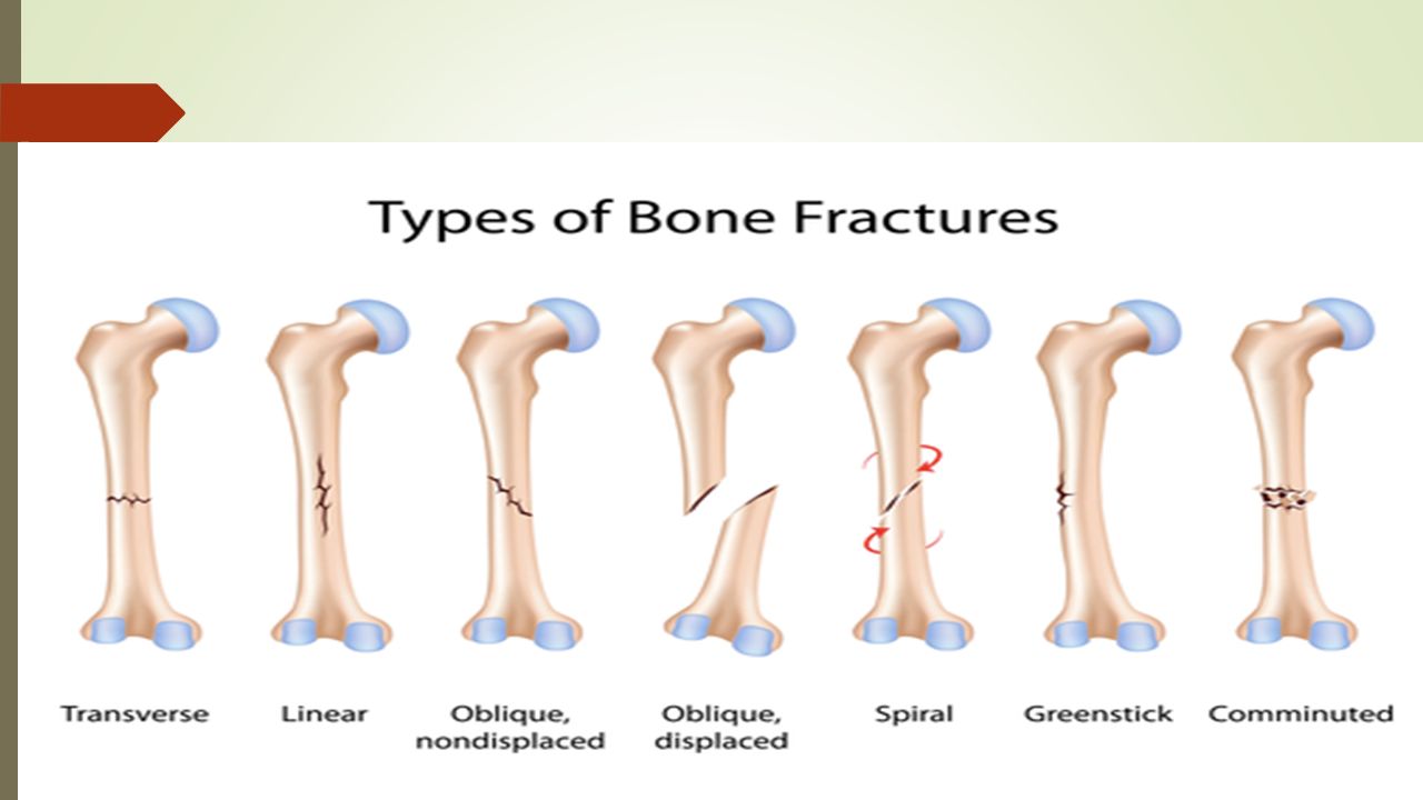 bone fracture types A fracture is a partial or complete break in the bone there are different causes and types of fractures symptoms include swelling and bruising. bone fracture types A fracture is a partial or complete break in the bone there are different causes and types of fractures symptoms include swelling and bruising.