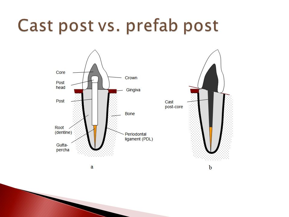 cast post and core