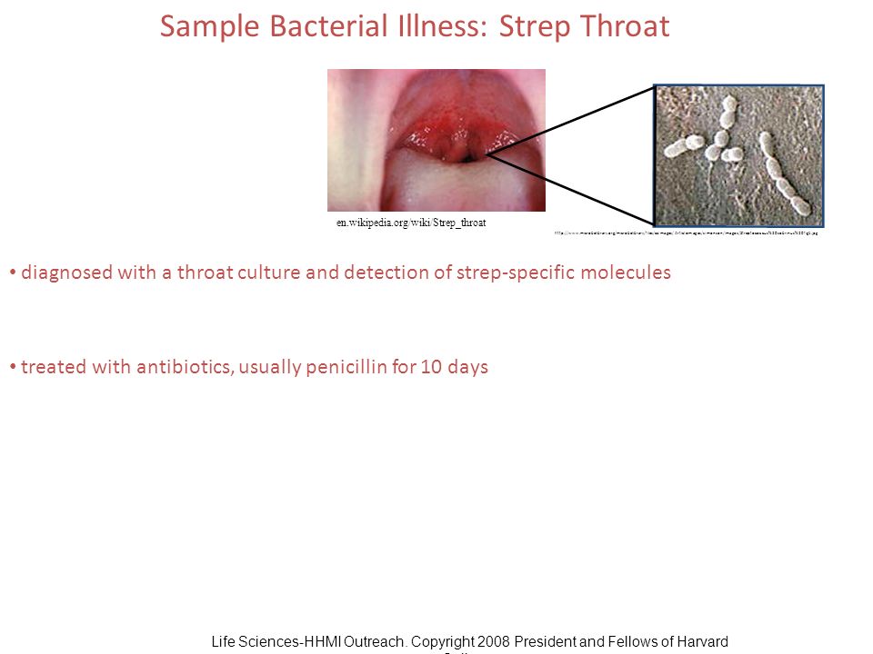 Strep throat wiki