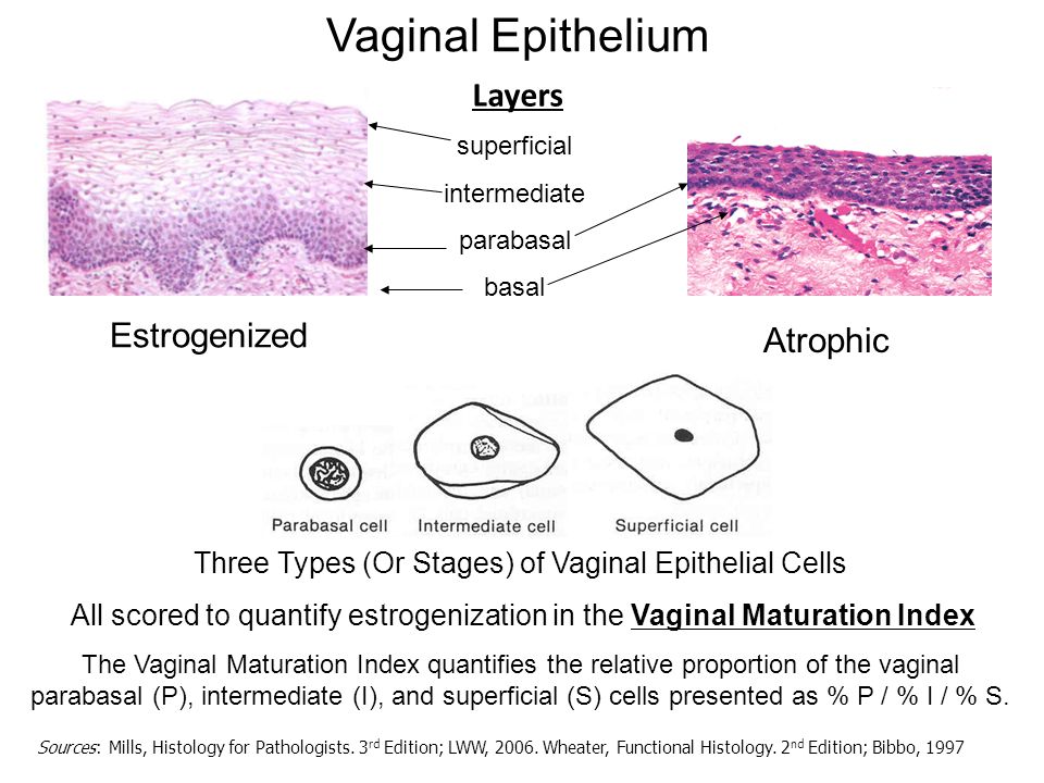 Aggressive undifferentiated carcinoma in the vagina