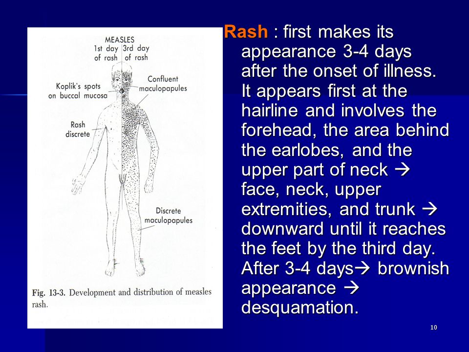 10 Rash : first makes its appearance 3-4 days after the onset of illness.