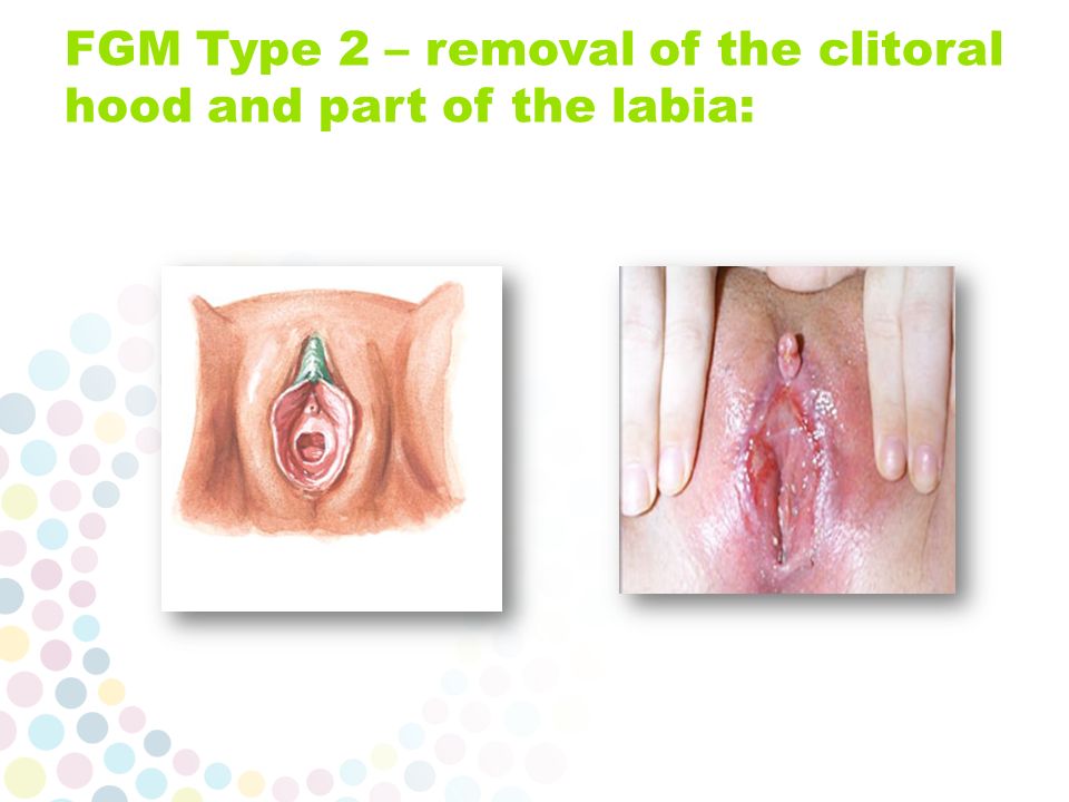 the clitoris hood The clitoris hood