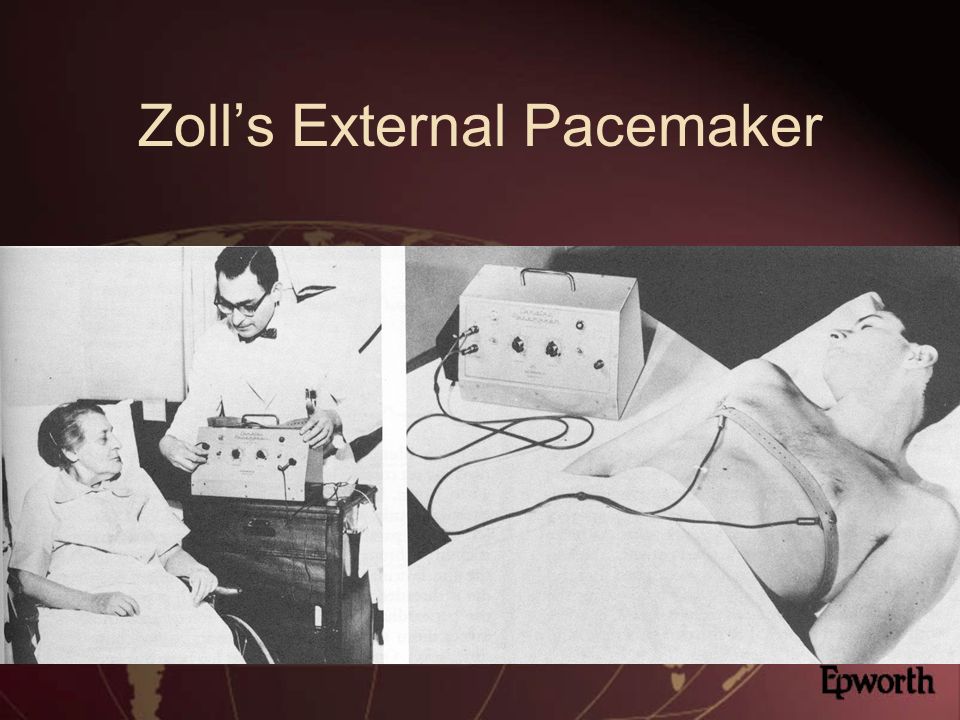 Zoll’s External Pacemaker