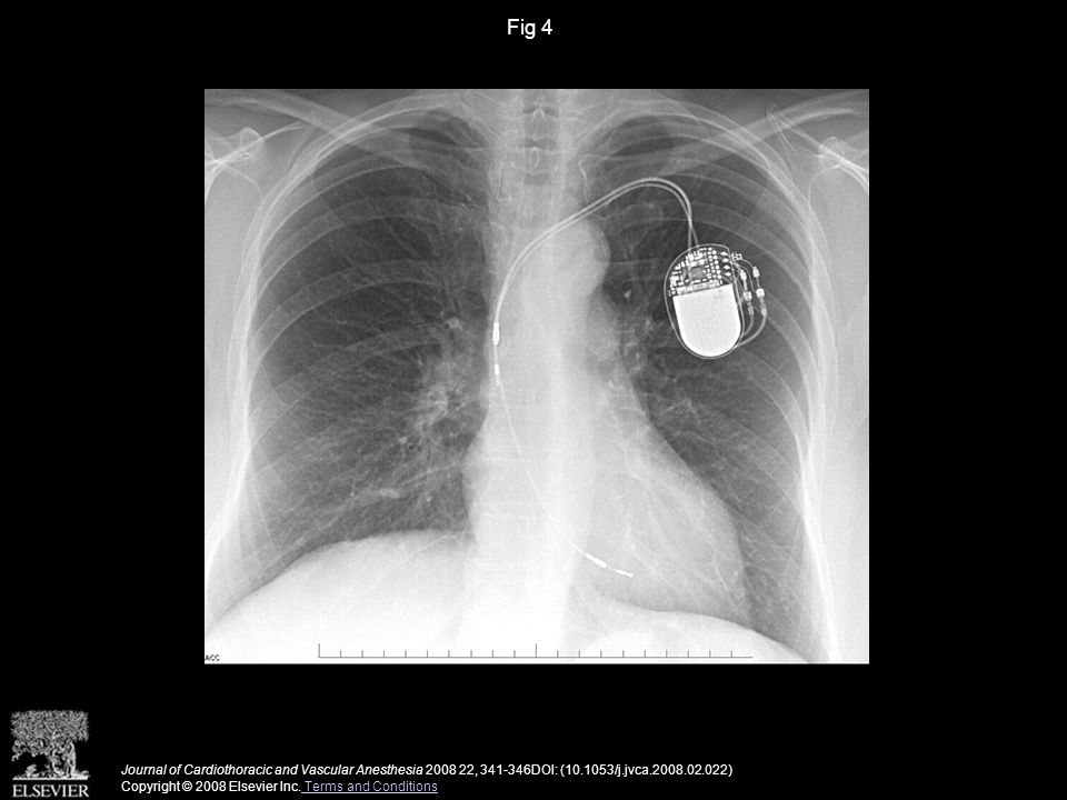 Fig 4 Journal of Cardiothoracic and Vascular Anesthesia , DOI: ( /j.jvca ) Copyright © 2008 Elsevier Inc.