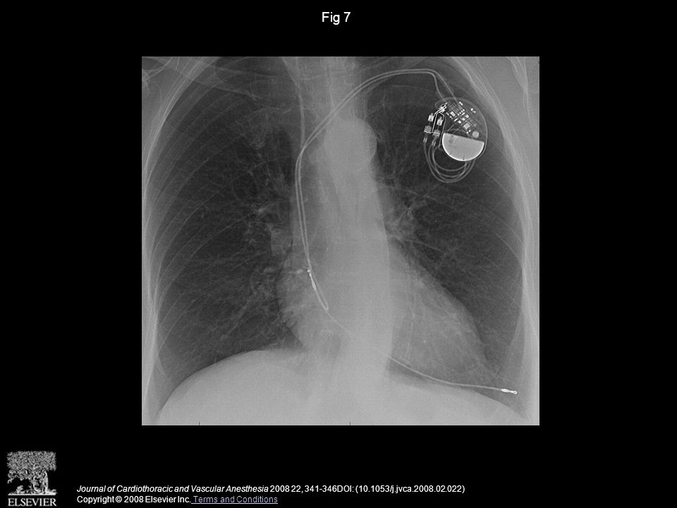 Fig 7 Journal of Cardiothoracic and Vascular Anesthesia , DOI: ( /j.jvca ) Copyright © 2008 Elsevier Inc.
