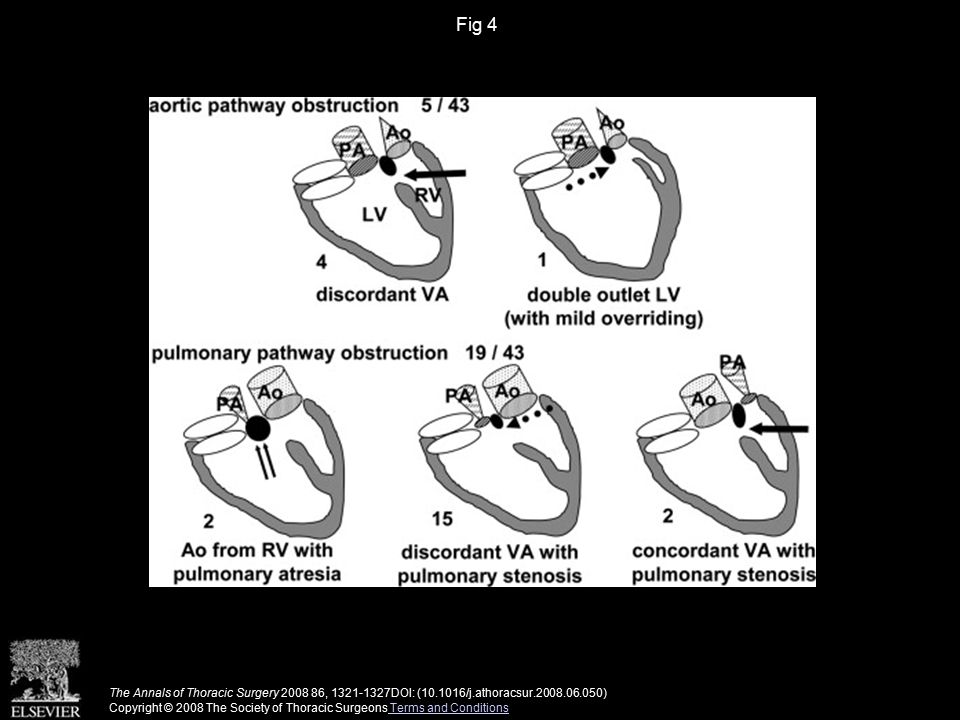 Fig 4 The Annals of Thoracic Surgery , DOI: ( /j.athoracsur ) Copyright © 2008 The Society of Thoracic Surgeons Terms and Conditions Terms and Conditions