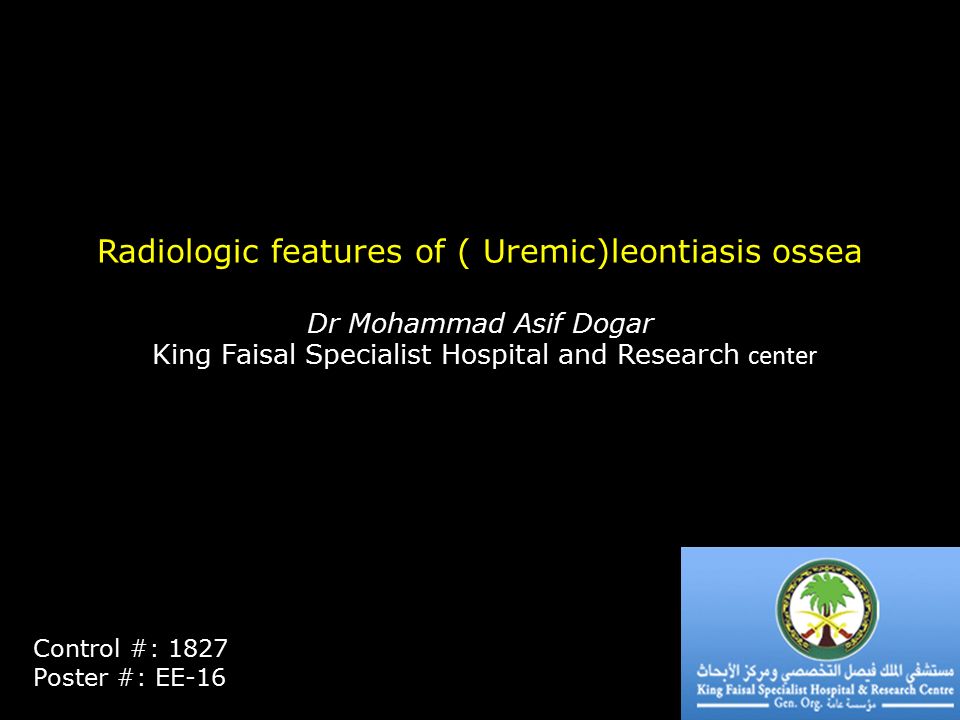 Radiologic features of ( Uremic)leontiasis ossea Dr Mohammad Asif Dogar King Faisal Specialist Hospital and Research center Control #: 1827 Poster #: EE-16