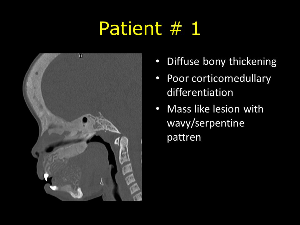 Patient # 1 Diffuse bony thickening Poor corticomedullary differentiation Mass like lesion with wavy/serpentine pattren