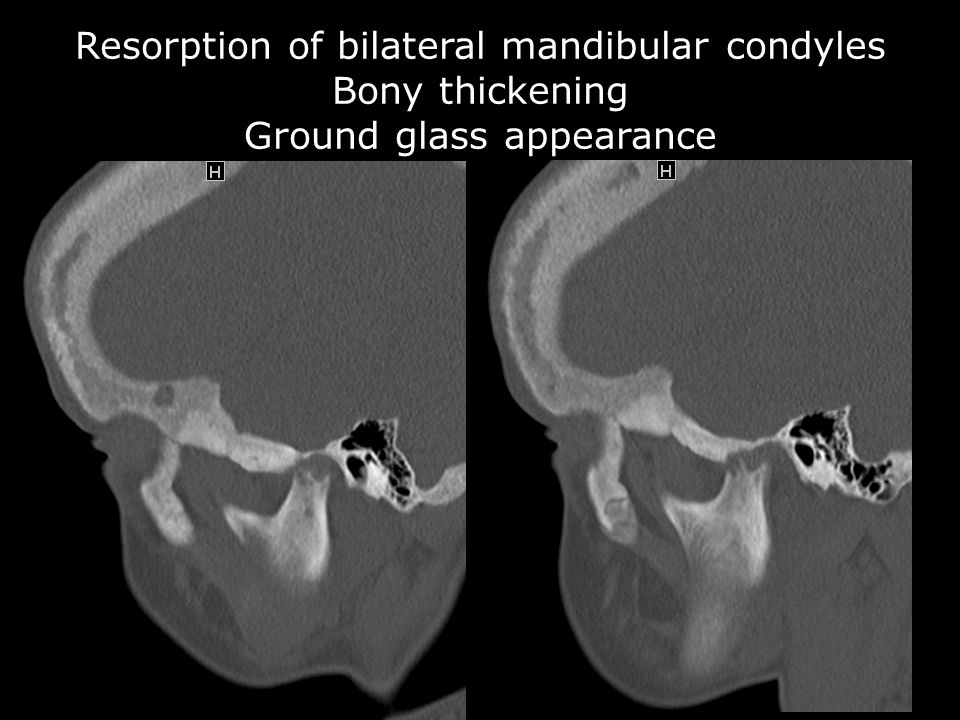 Resorption of bilateral mandibular condyles Bony thickening Ground glass appearance